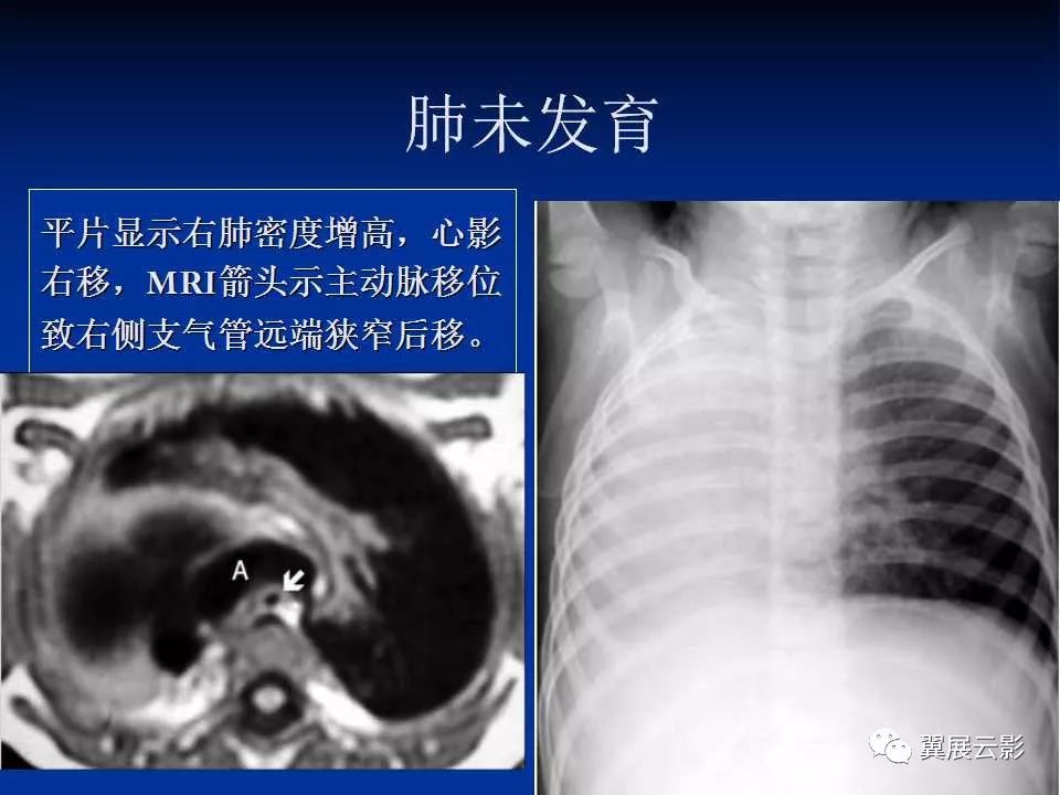 12种肺部先天性发育异常的影像表现