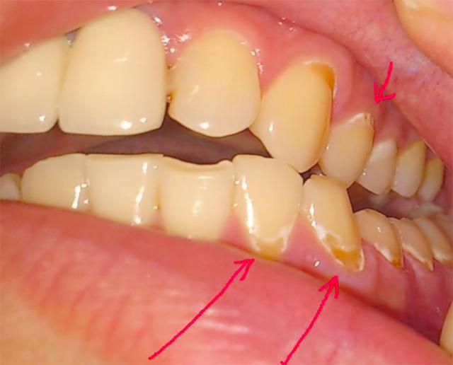牙齿根部长出又黄又硬的脏东西用3招即可清除干净