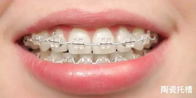 1陶瓷托槽矫治技术牙套有哪些种类?怎么选择?