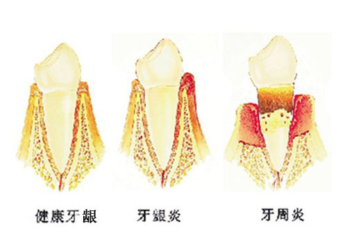 上的死角,即使再認真刷牙,也沒有辦法清潔乾淨,進而形成齲齒及牙齦炎