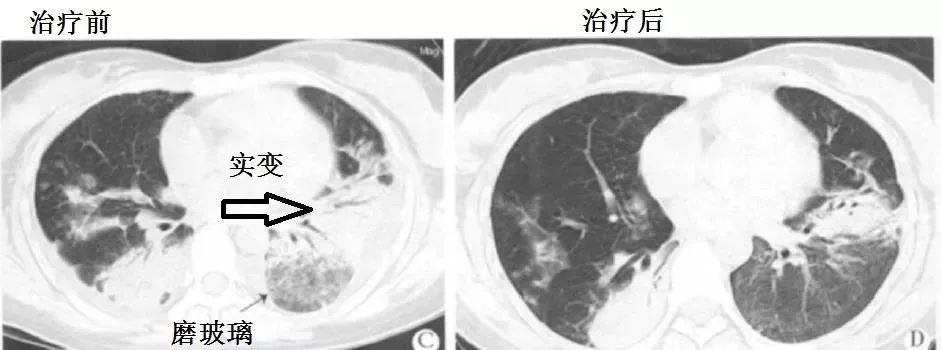 【推薦】流感不是問題,關鍵是病毒性肺炎在搞事!