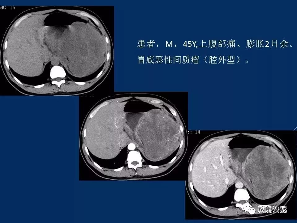 15个病例熟悉胃肠道间质瘤影像表现