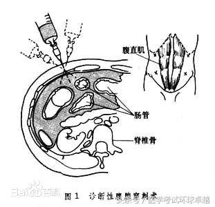 2018臨床執業醫師實踐技能考點腹腔穿刺和骨髓穿刺