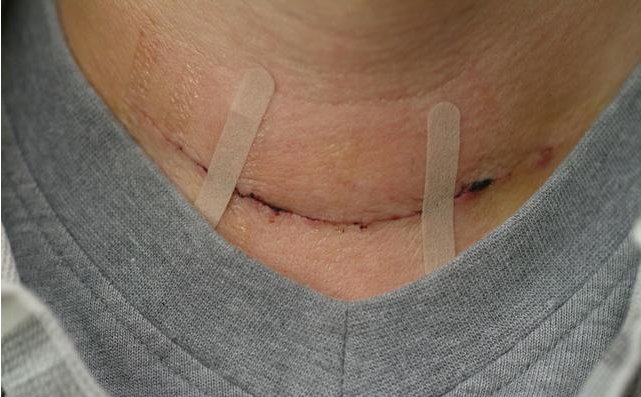 甲状腺结节手术看了这些图片你还敢在大脖子上动刀吗