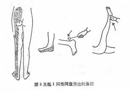 6,肌力下降 7,反射異常 腰椎間盤突出症典型體位 脊柱側彎與突出