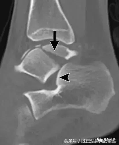 距骨骨折和脫位放射科醫生指南