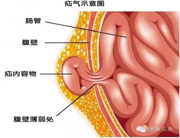 腹外疝的解剖图片图片