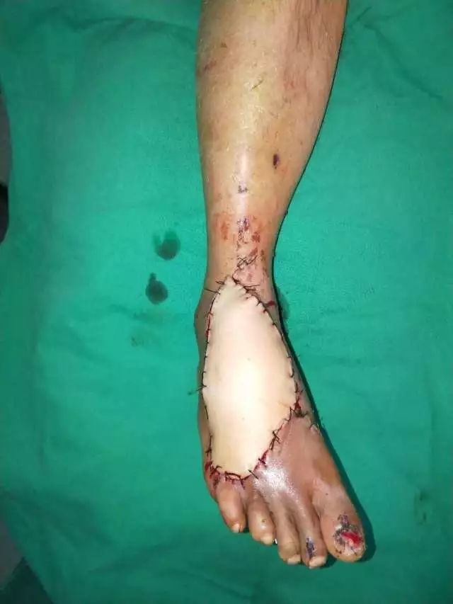 表面损伤外,左脚大拇指也有部分离断,由于来院前的断肢再植成活不理想