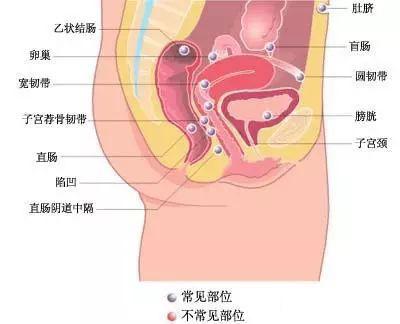 在體檢時尤其進行陰道,直腸三合診時會發現子宮後位,固定而且在陰道