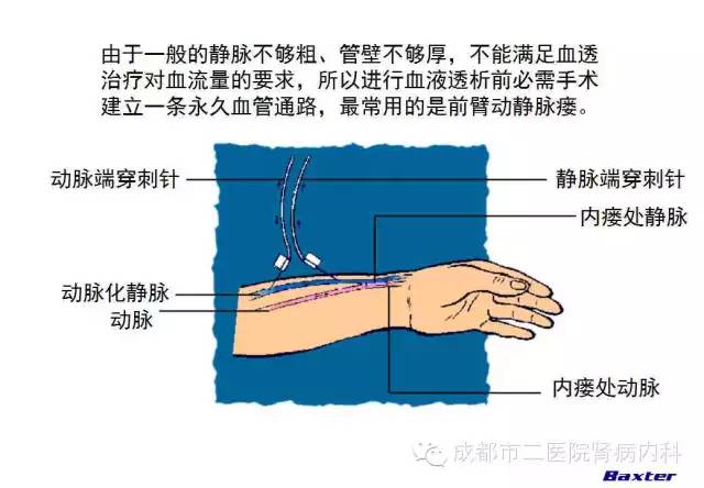 血液透析和腹膜透析,哪个适合我?