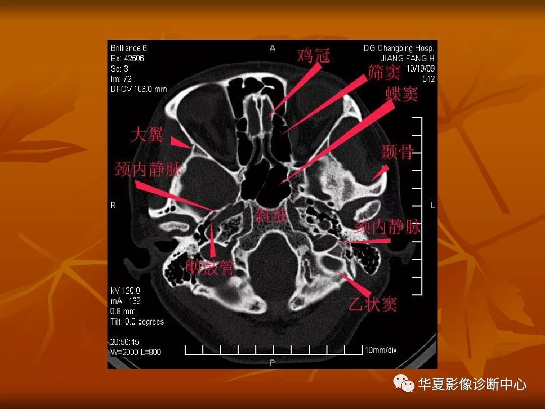 最全的顱骨ct解剖及外傷骨折的診斷