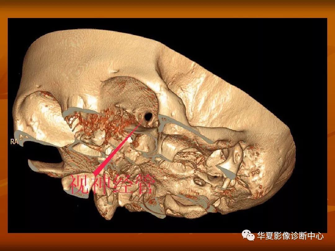 最全的顱骨ct解剖及外傷骨折的診斷