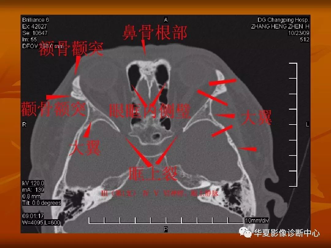 颧骨断层解剖图图片