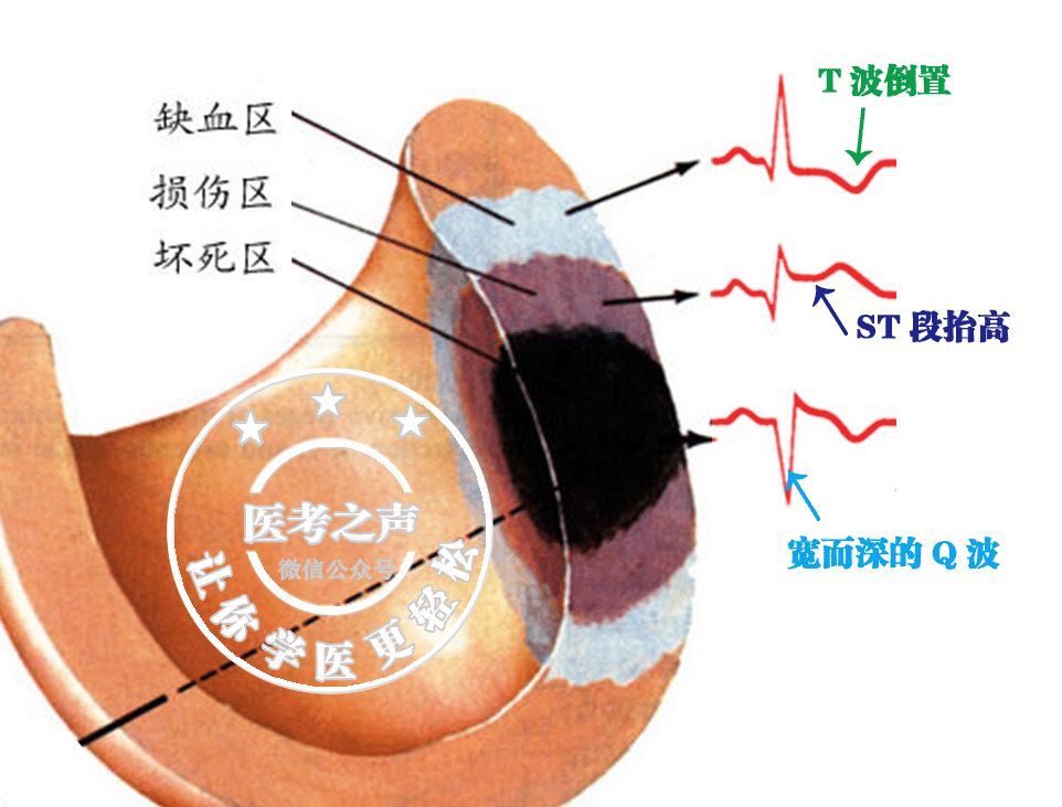 改變:t波高聳/倒置三世同堂典型急性心梗心電圖特點來綜合考慮患者