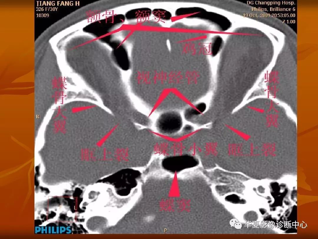 最全的颅骨ct解剖及外伤骨折的诊断