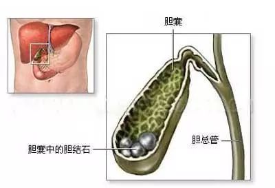 人的胆囊像一座小仓库,具有储存一部分胆汁的功能,吃早餐可以促使胆囊