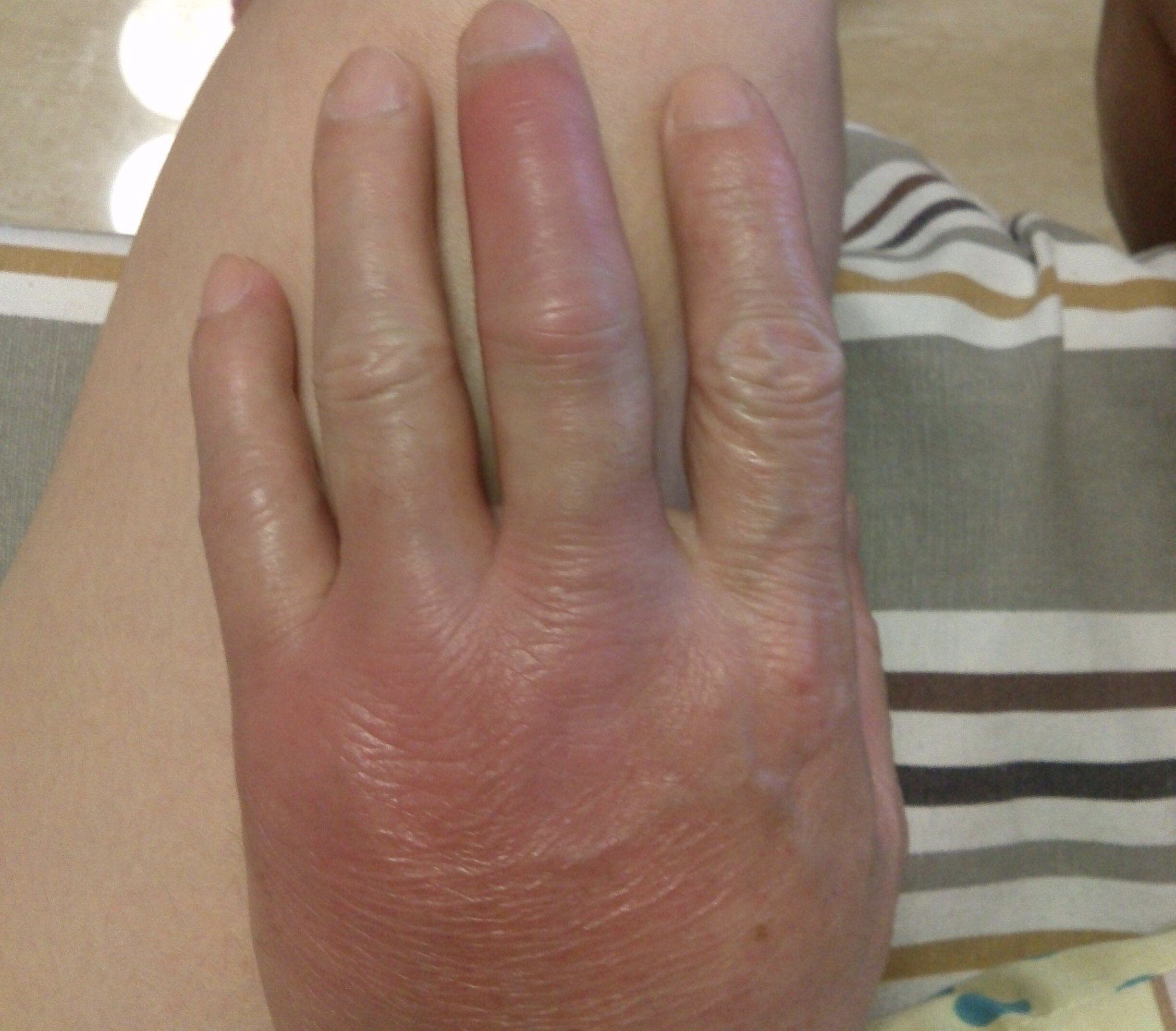 该阶段的痛风症状主要表现为脚踝关节或脚指,手臂,手指关节处疼痛
