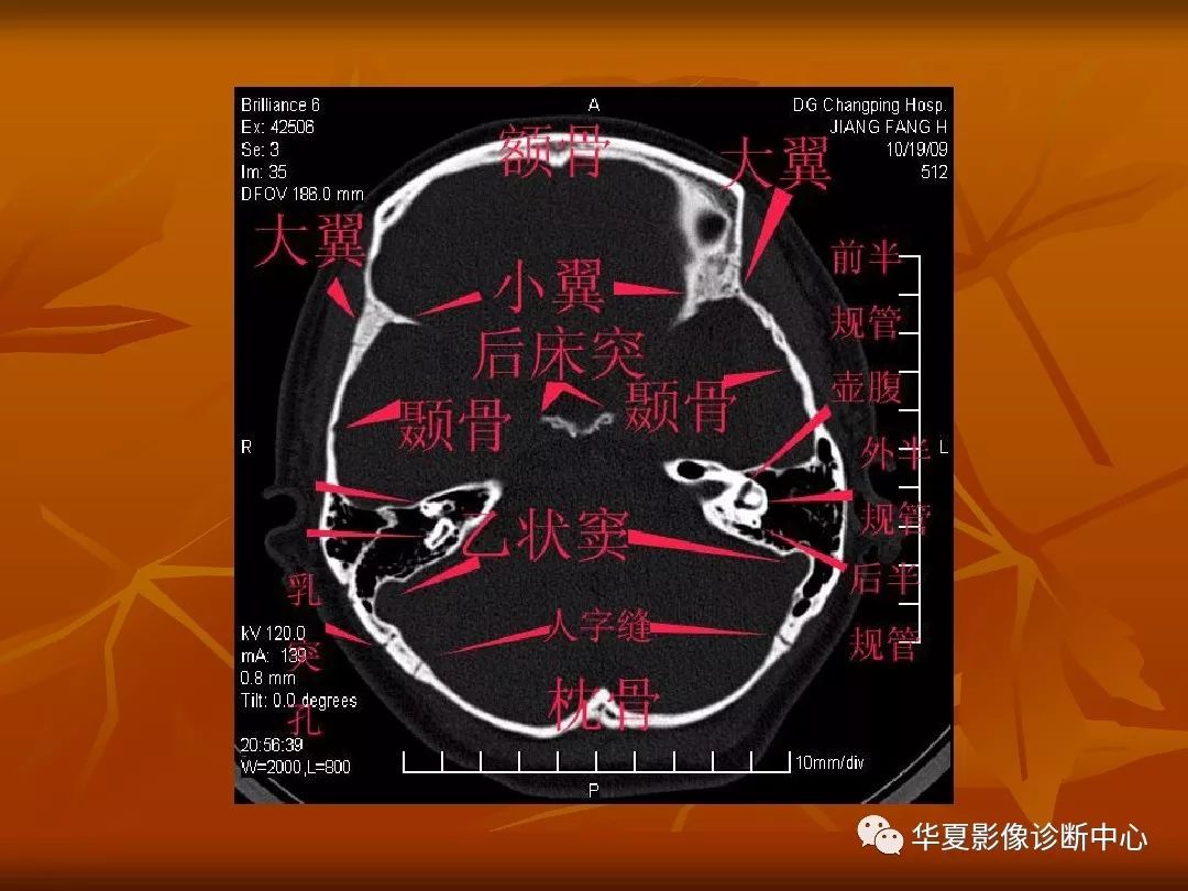 最全的颅骨ct解剖及外伤骨折的诊断