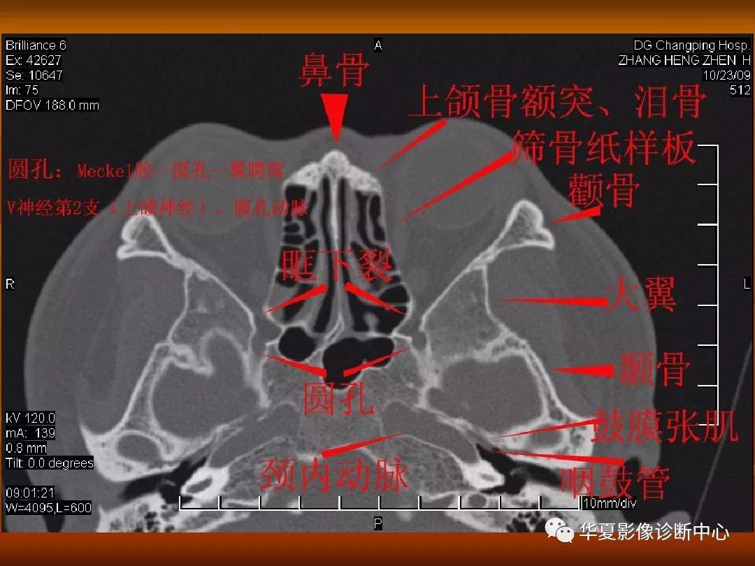 颅骨解剖结构图ct图片