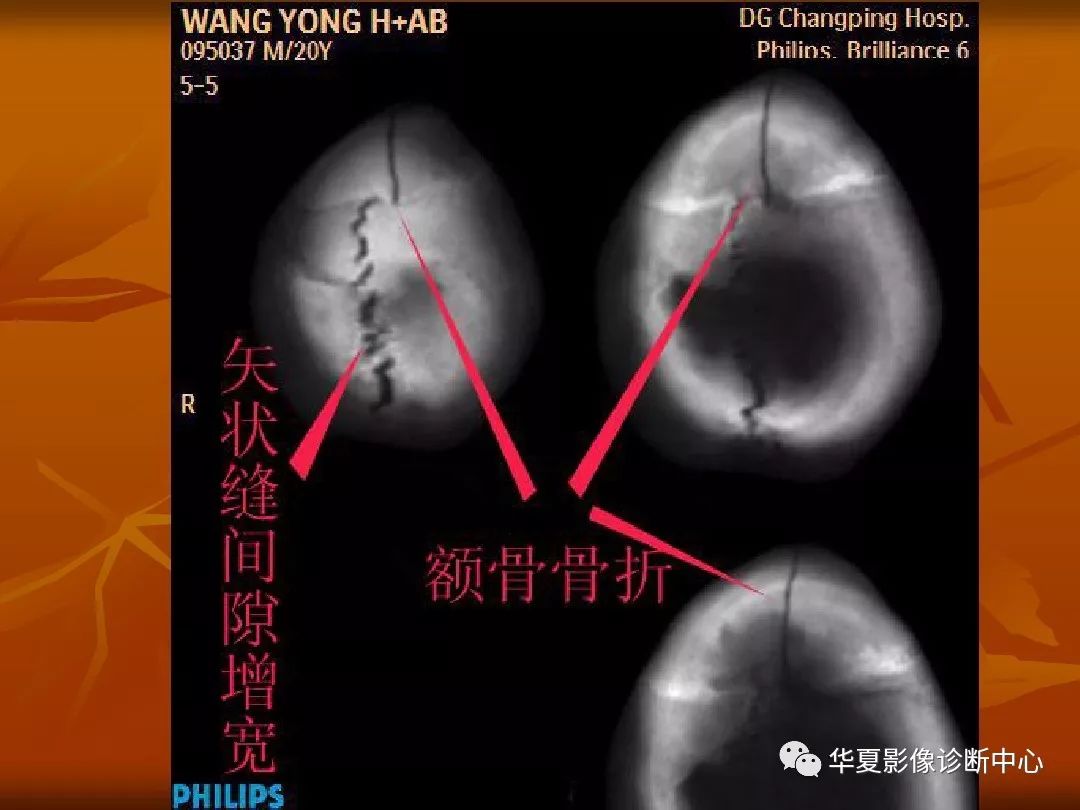 最全的顱骨ct解剖及外傷骨折的診斷