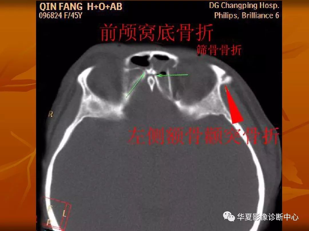 最全的顱骨ct解剖及外傷骨折的診斷