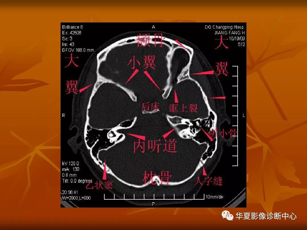 最全的顱骨ct解剖及外傷骨折的診斷