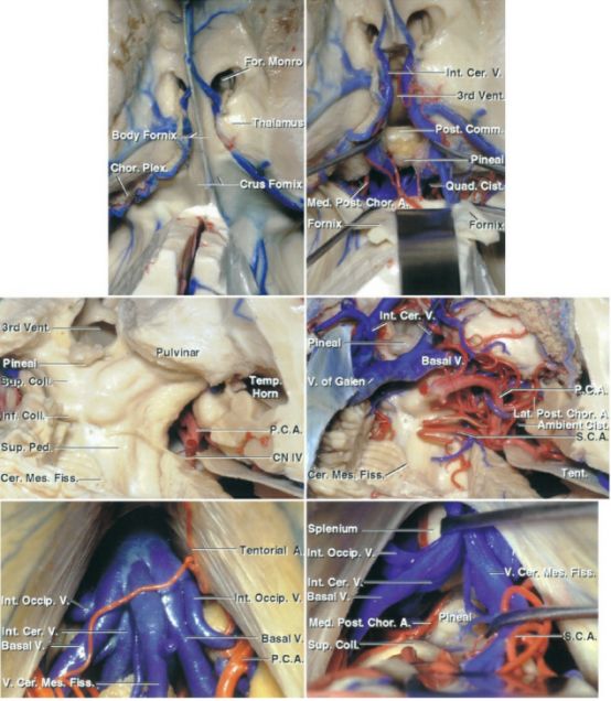 松果體區腫瘤手術入路策略與技巧theneurosurgicalatlas全文翻譯