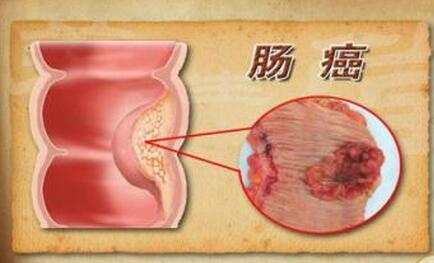 直肠出血 预示:老年性肠癌