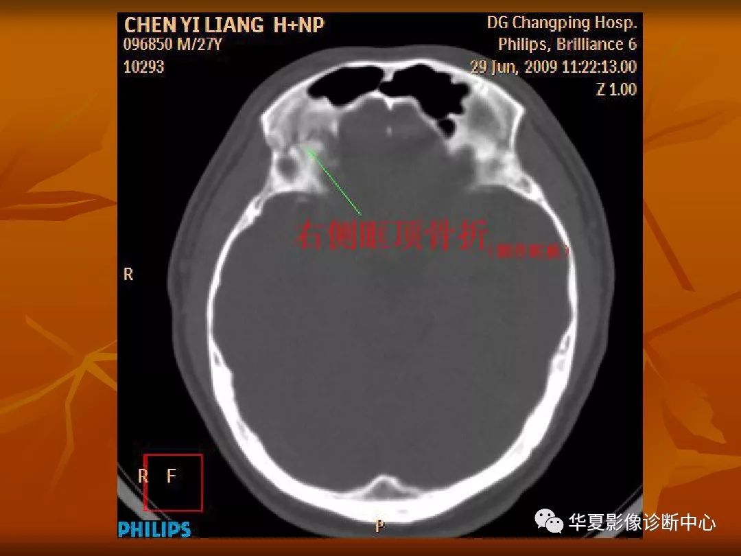 最全的顱骨ct解剖及外傷骨折的診斷