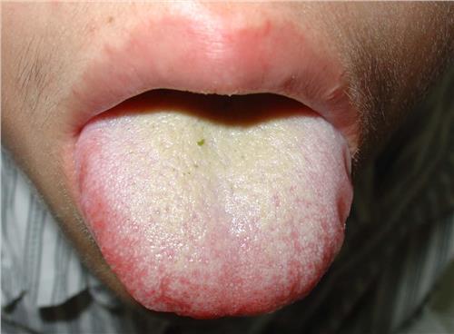 症状三:看舌苔风寒感冒引起的咽喉痛不明显;风热感冒通常伴有咽喉疼痛