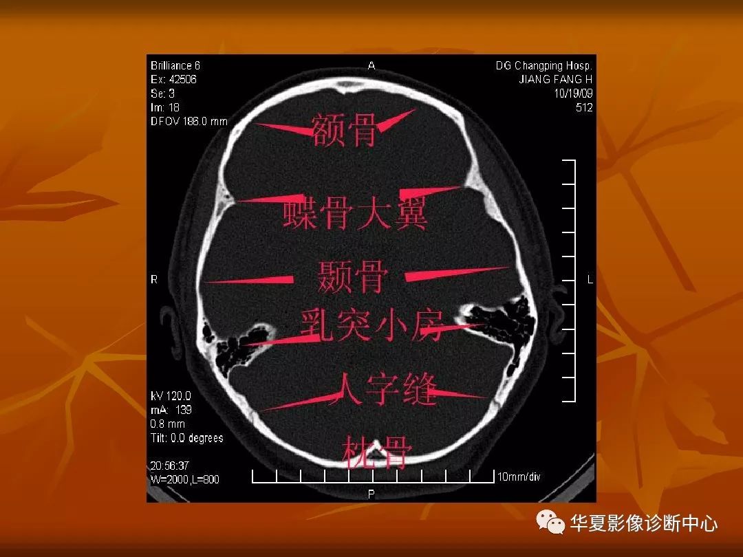 最全的顱骨ct解剖及外傷骨折的診斷