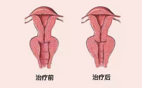 阴道紧缩术能维持多久？