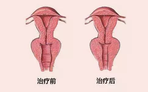 做完阴道紧缩术能生孩子吗？