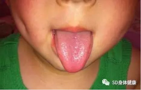 宝宝舌头下筋发紫图片图片