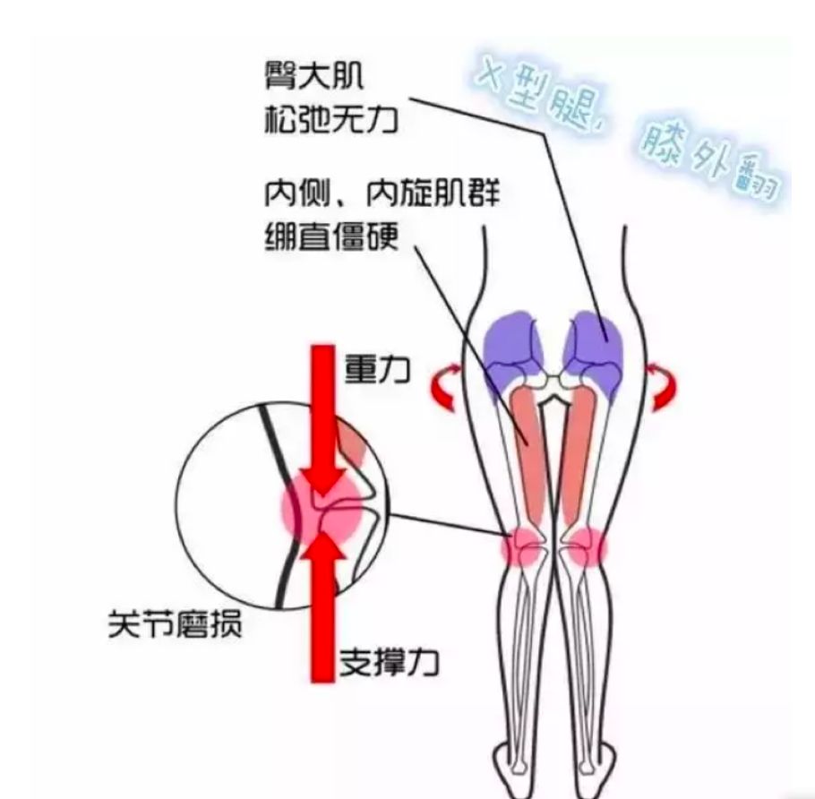 自然o型腿的就是膝盖内侧软骨压力更大,更容易磨损啦