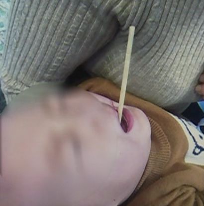 儿童玩筷子受伤图片图片