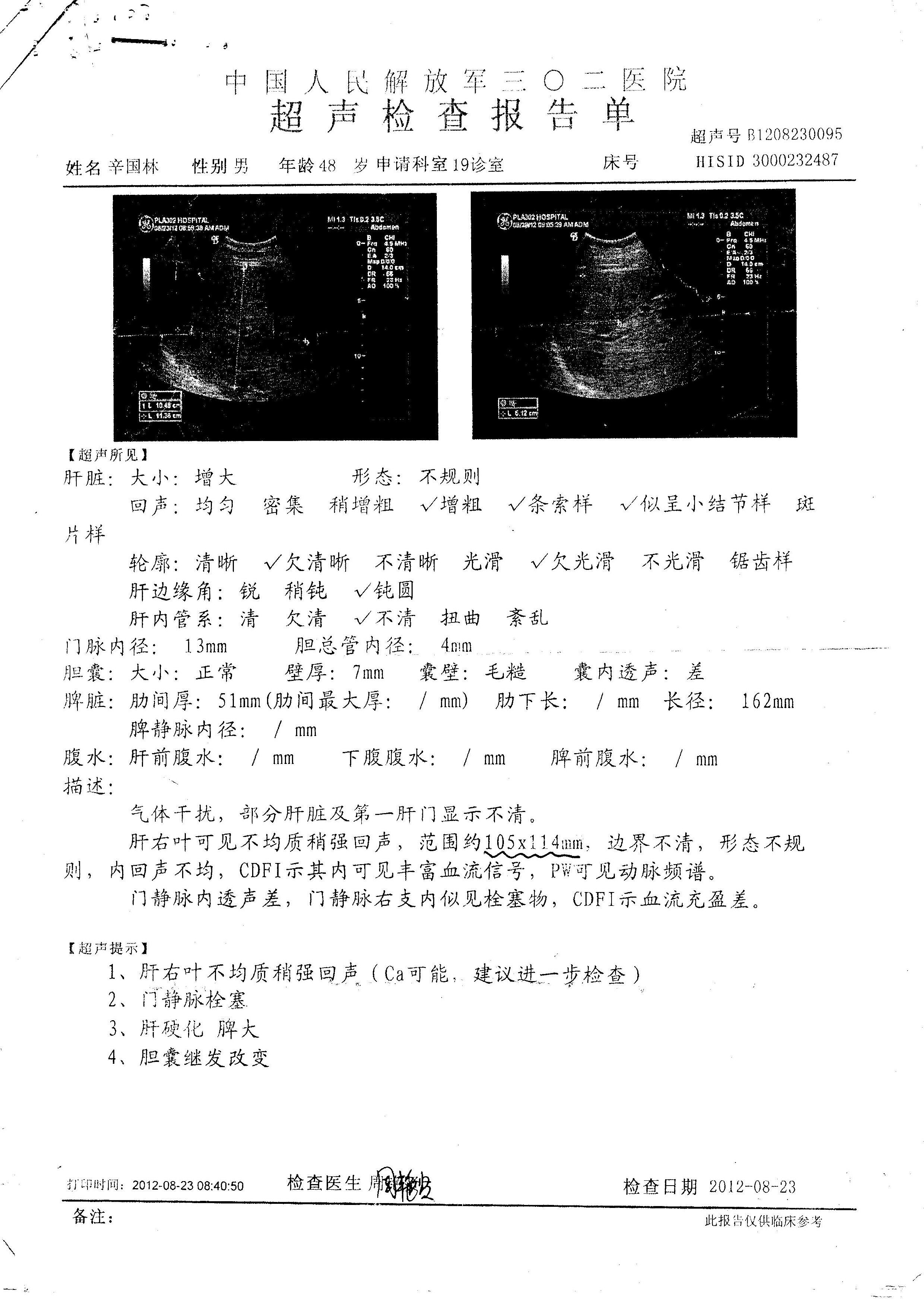 肝癌自测19招图片