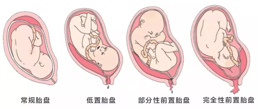 各种胎盘位置图 前壁图片