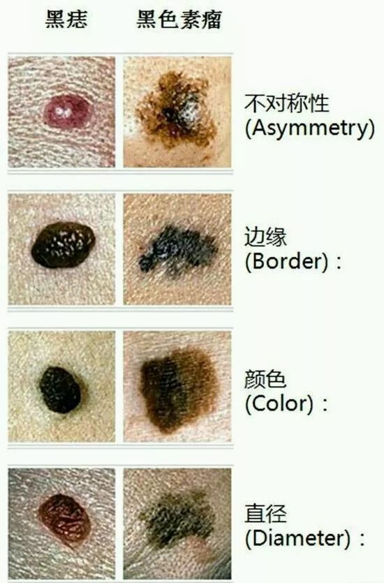 如何判断黑色素瘤图片