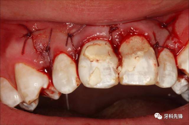 【病例】埋伏尖牙压迫多颗牙根吸收的外科 内科联合处理