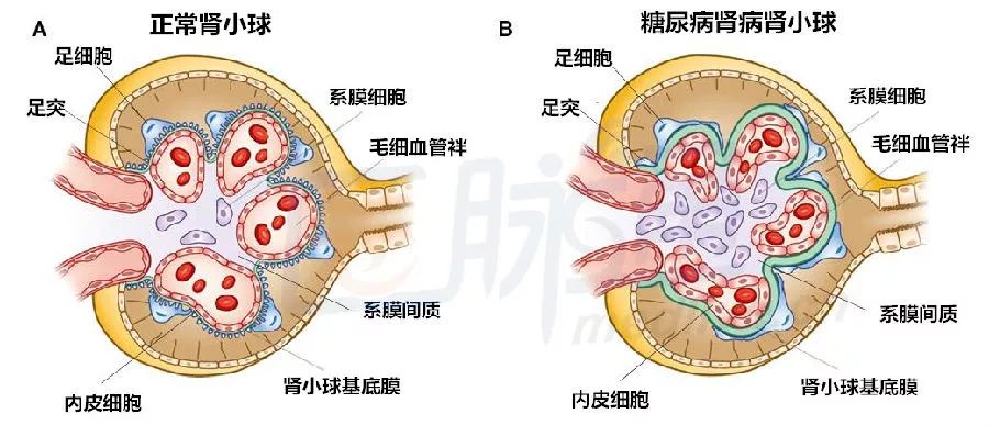 其他肾小球改变包括内皮细胞窗孔丧失,肾小球系膜基质扩张,足细胞丢失