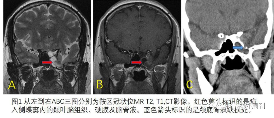 头颅mri检查示:左侧颞叶部分脑组织及脑脊液