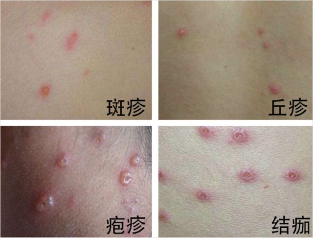 皮疹的四代同堂是水痘特有的症状结痂开始脱落,不留瘢痕1~2周发病后