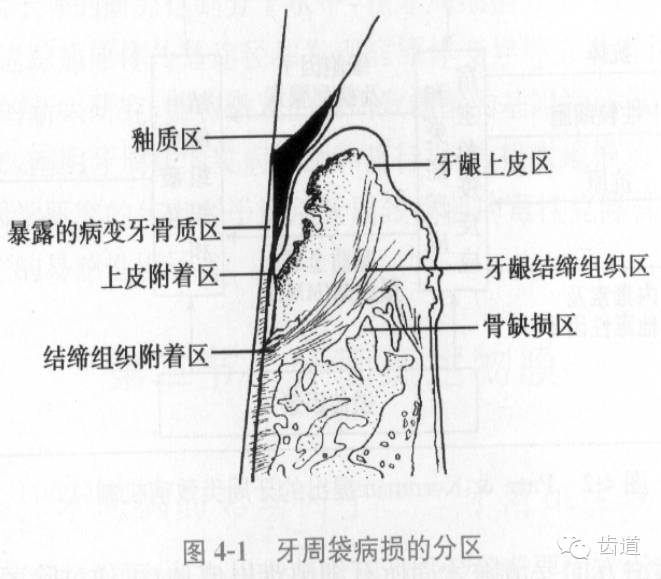 牙龈解剖图图片