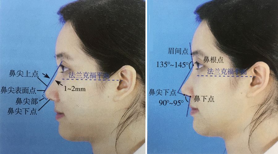 眉間點和鼻樑在鼻根點位置的角度保持在135～145度,鼻唇角度在90～95