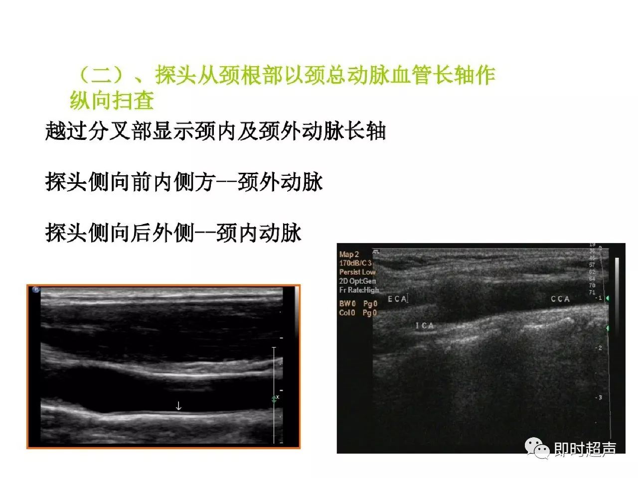 頸部血管超聲正常解剖及常見病的超聲診斷標準