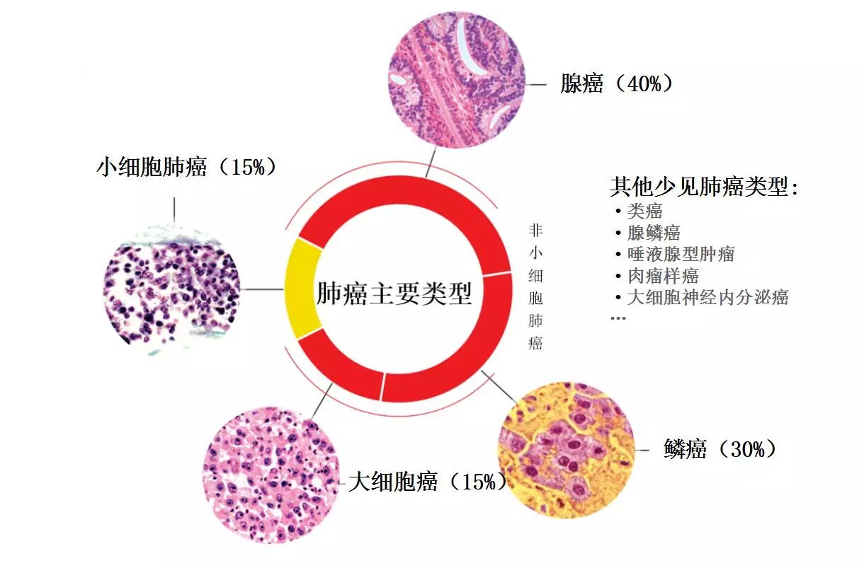 肺癌病理分期图片