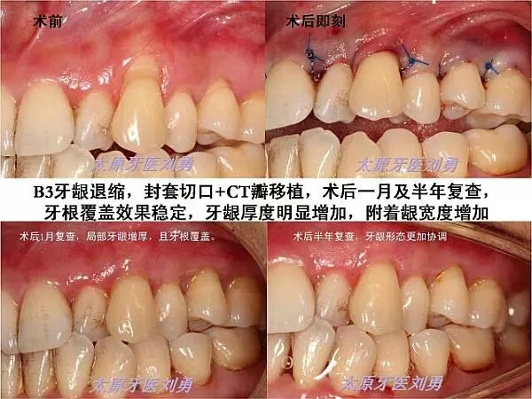 附着龈增宽术图解图片