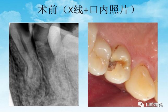 前磨牙根管治療後高嵌體修復病例