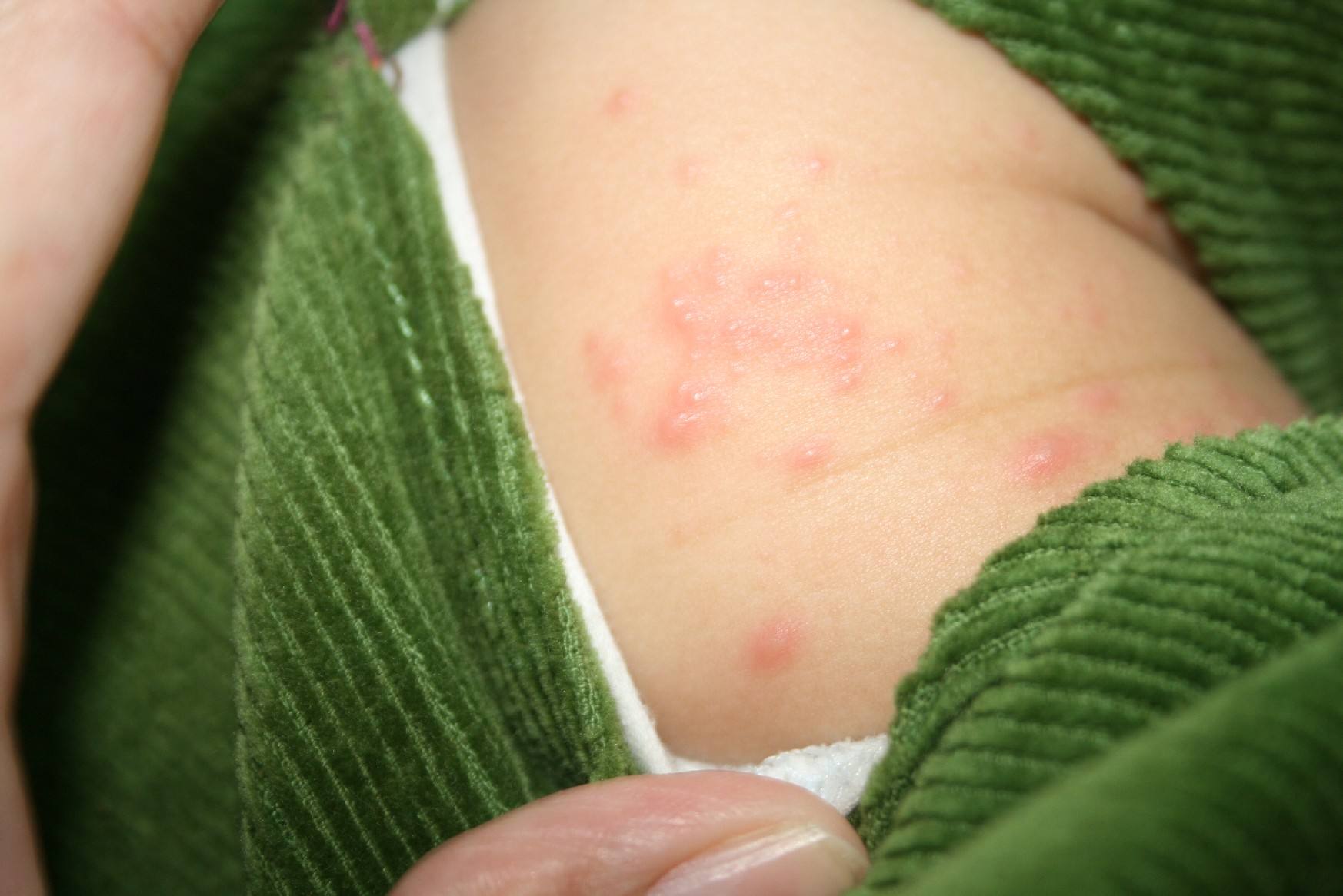 小婴儿皮肤娇嫩, 湿疹来了怎么护理?